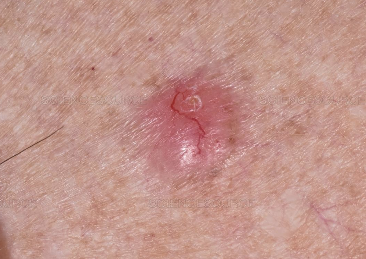 basal cell carcinoma BCC